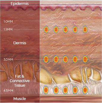 Cheap Ultherapy laser lifting treatment in Seoul