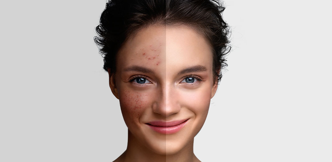 Best skincare facials for acne in Seoul