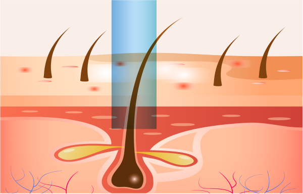 Best acne laser treatment in Seoul