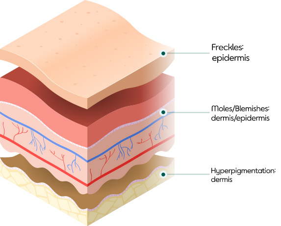 Painless pigmentation treatment in Seoul - recommendations for skincare clinic with English speaking staff