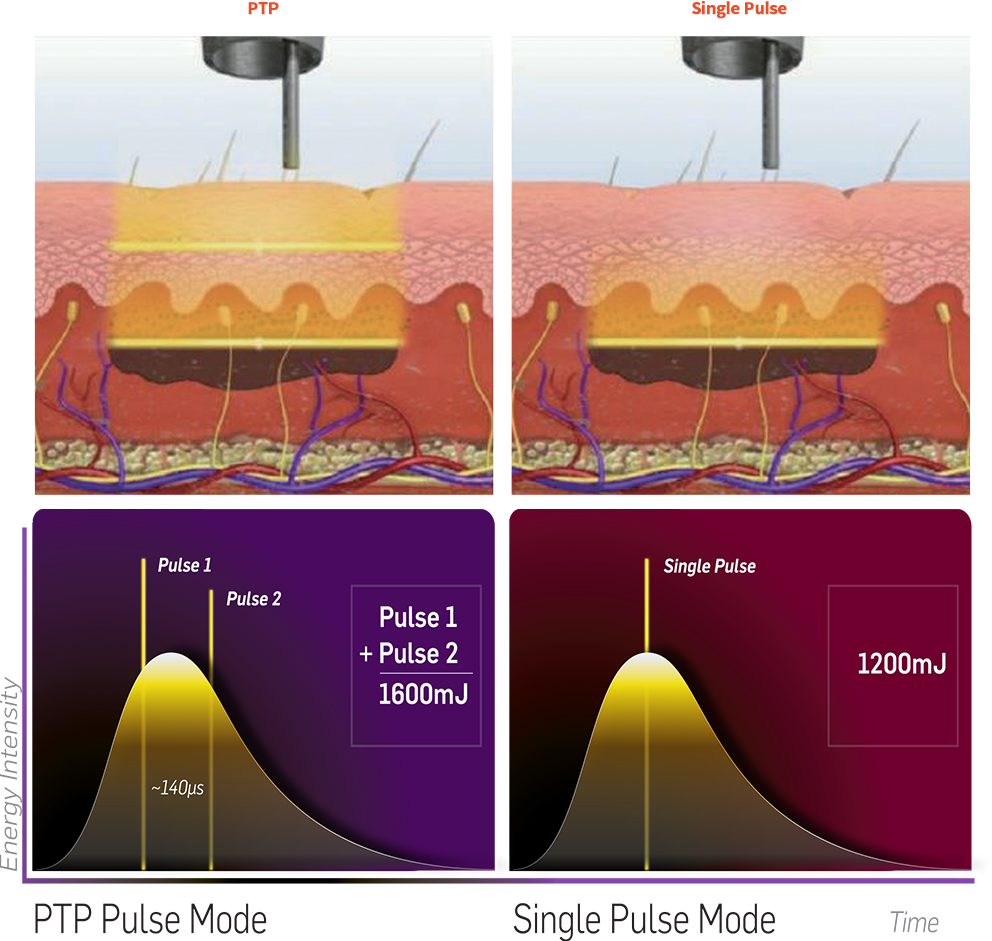 Revlite SI acne laser treatment, affordable beauty clinic in Seoul, Gangnam, Myeongdong, Hongdae, South Korea