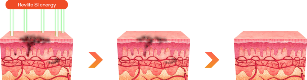 Revlite acne laser treatment, best English skin clinic in Seoul